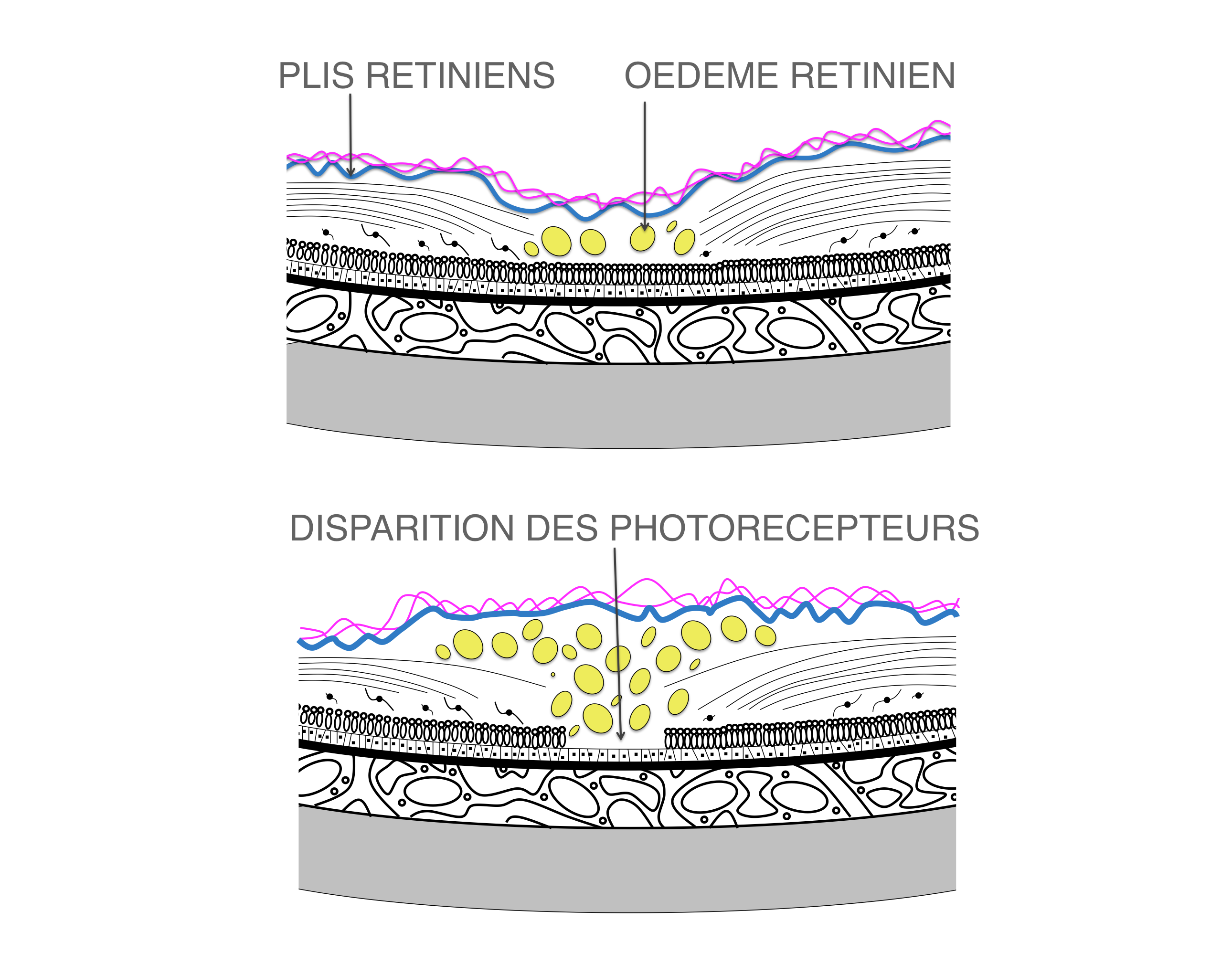 membrane épirétinienne compliquée d'oedème intra rétinien maculaire marquée pouvant être à l'origine d'une perte irréversible des photorécepteurs