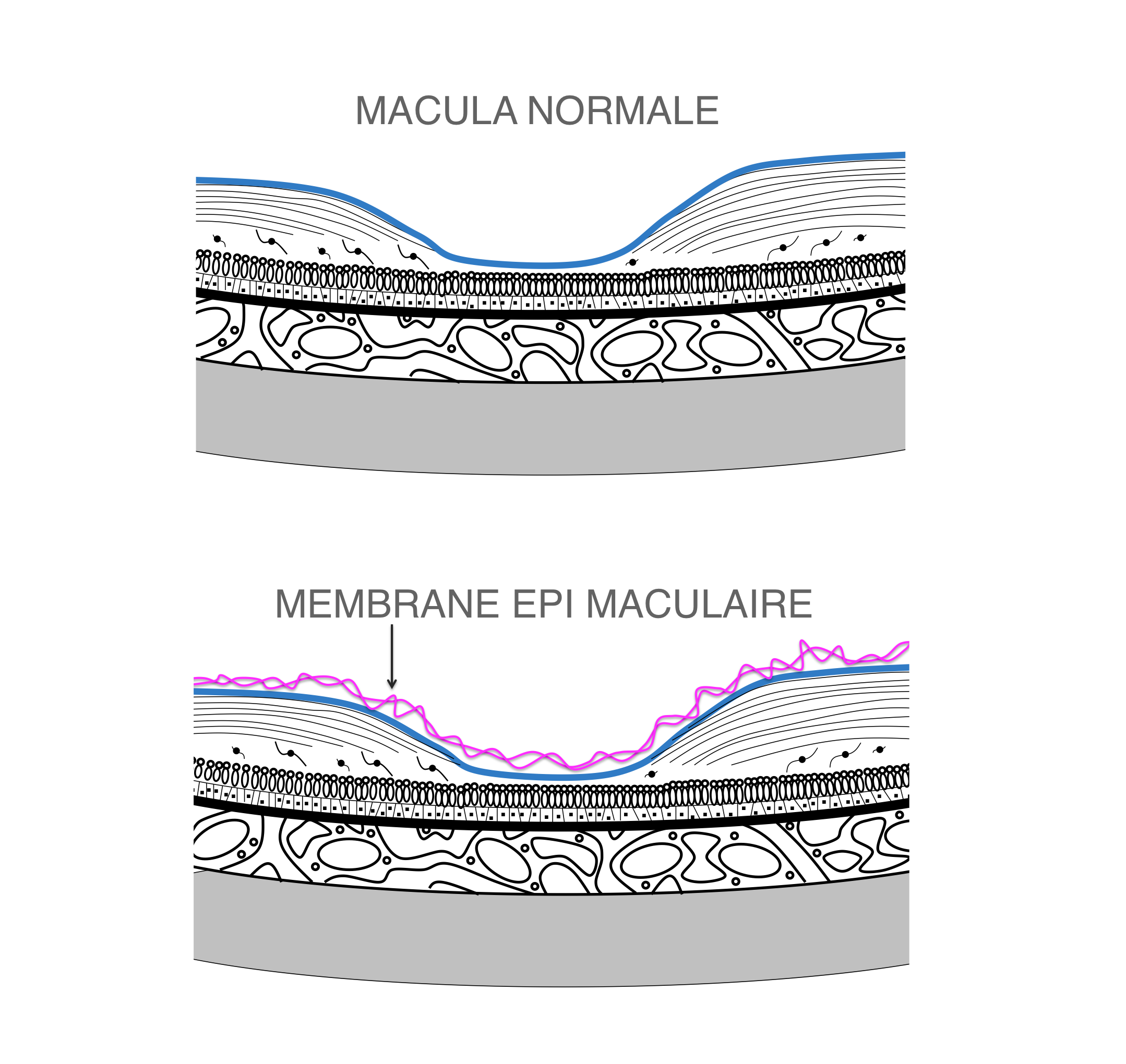 comparatif rétine normale et rétine présentant une membrane épirétinienne