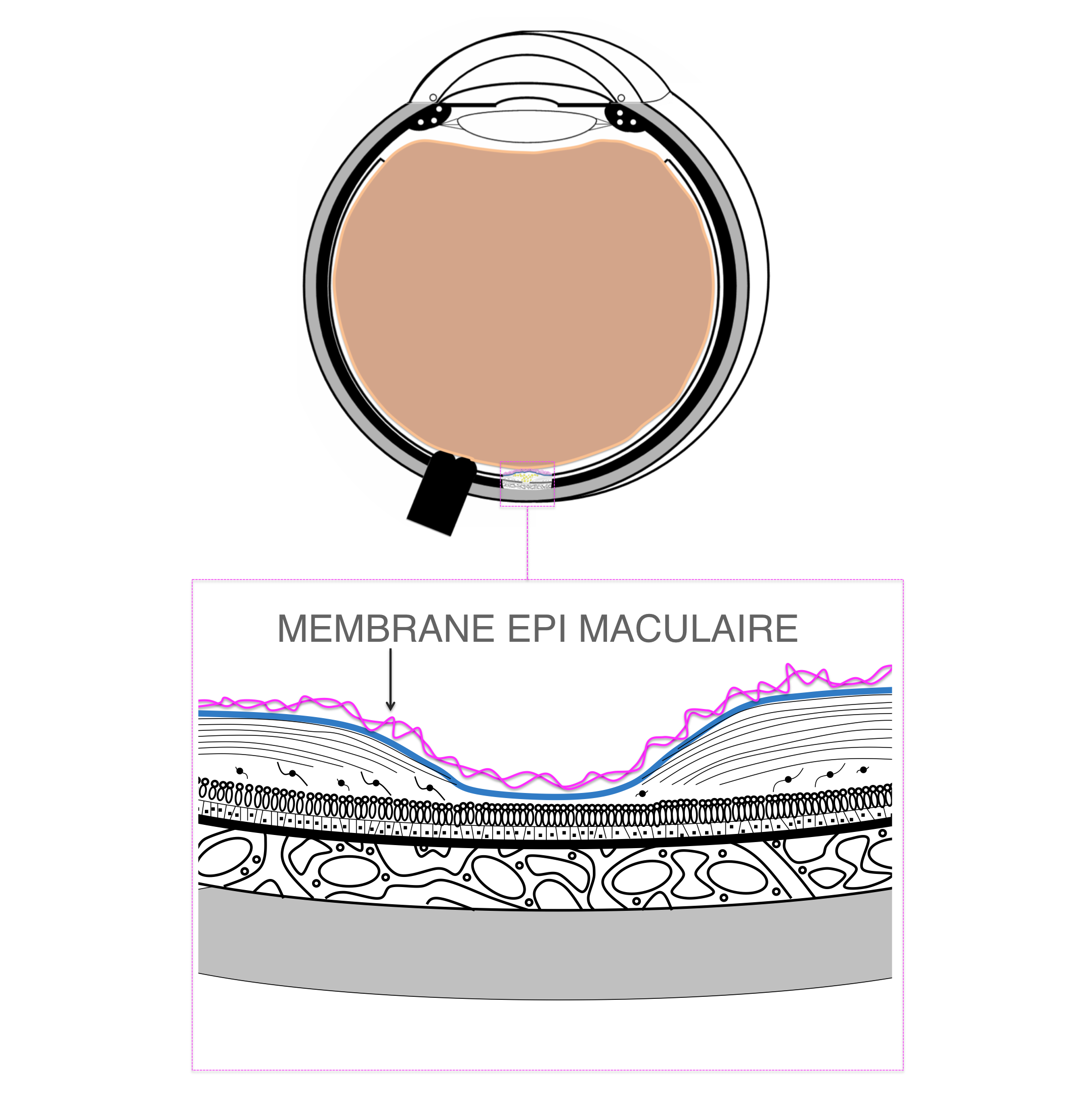 membrane épi-rétinienne : localisation anatomique
