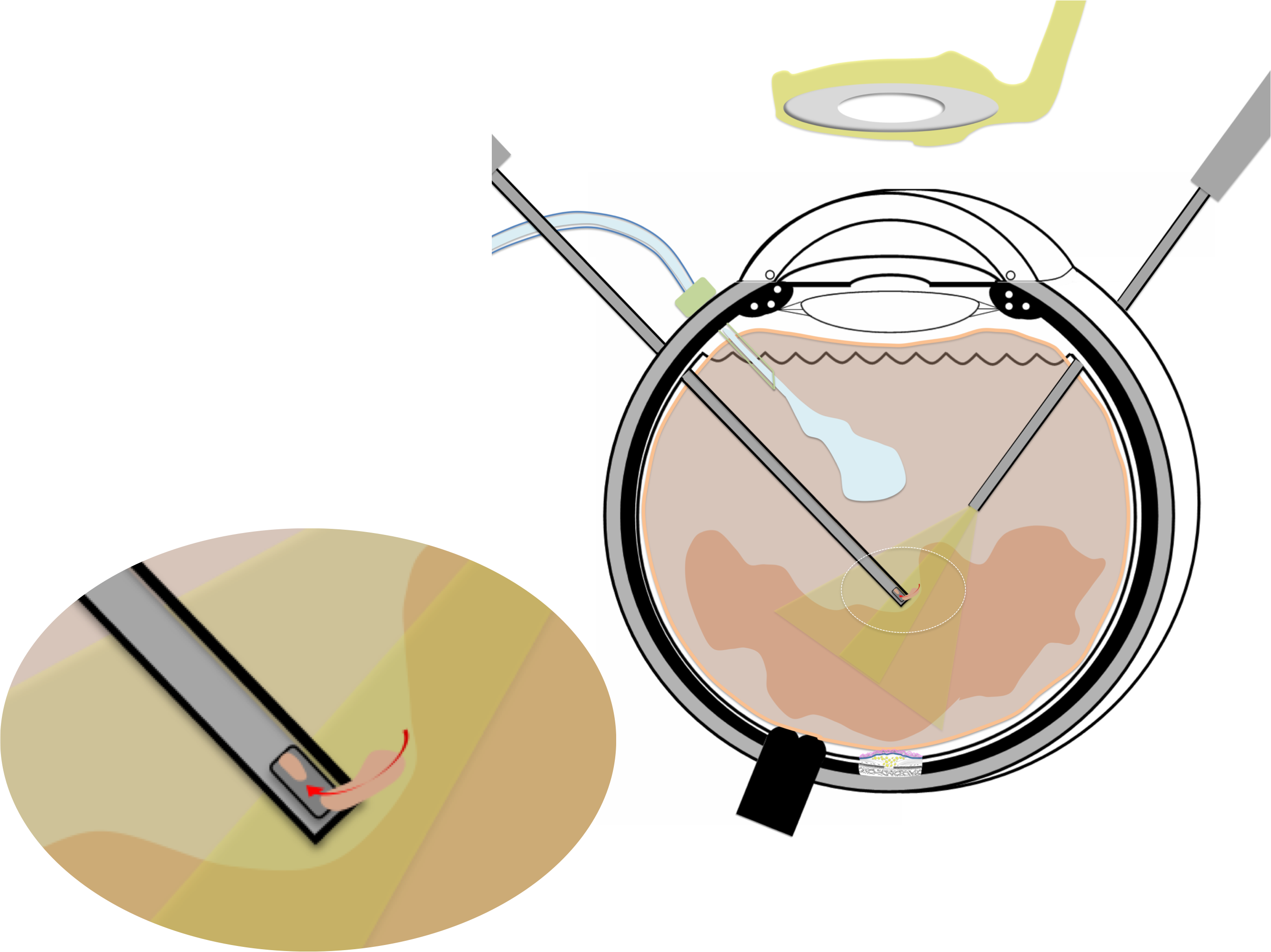 membrane épirétinienne prise en charge chirurgicale par vitrectomie : résection du gel vitréen qui est sectionné et aspiré