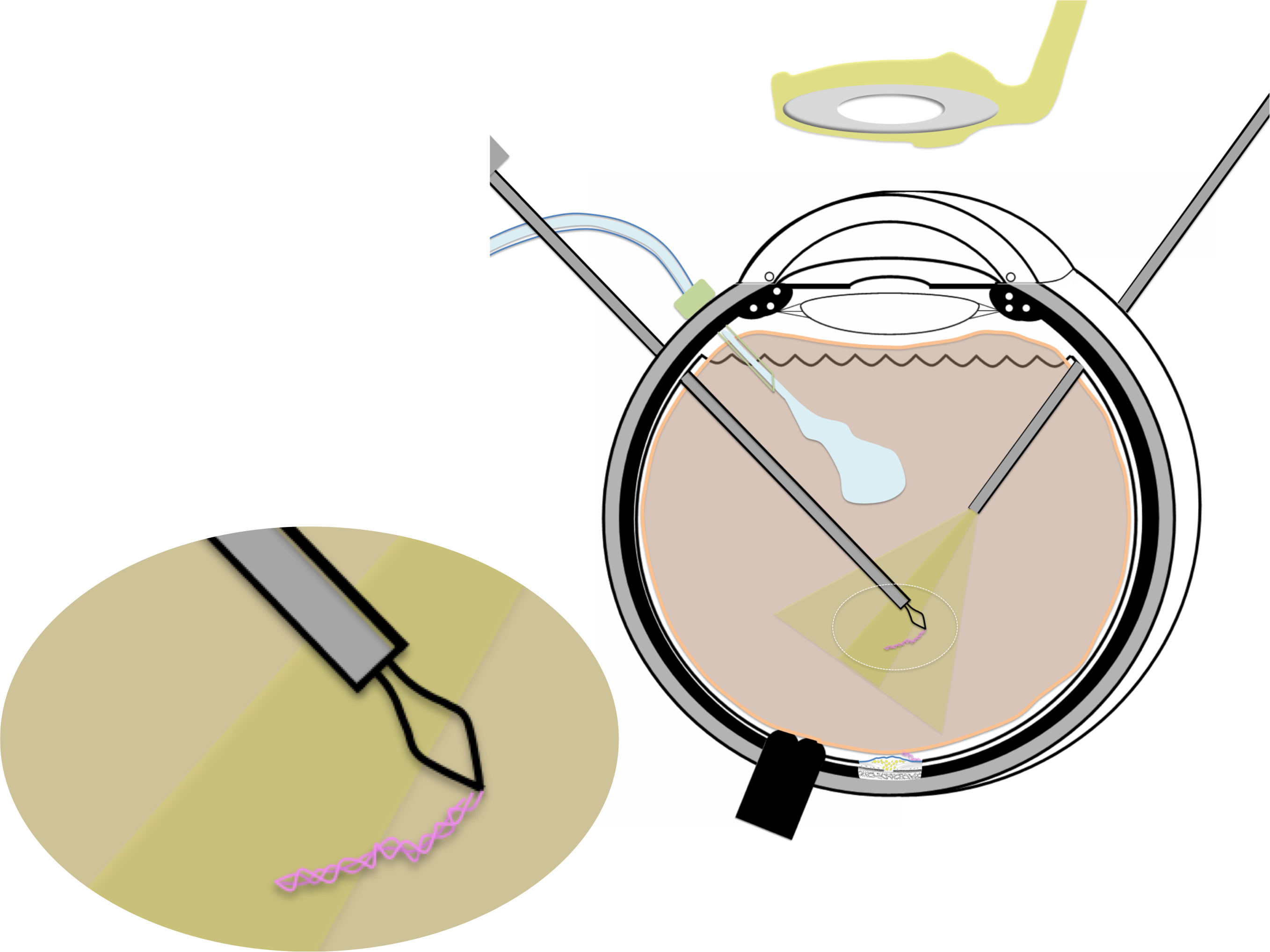 membrane épirétinienne prise en charge chirurgicale par vitrectomie : les différents fragments de membrane sont retirés de proche en proche 