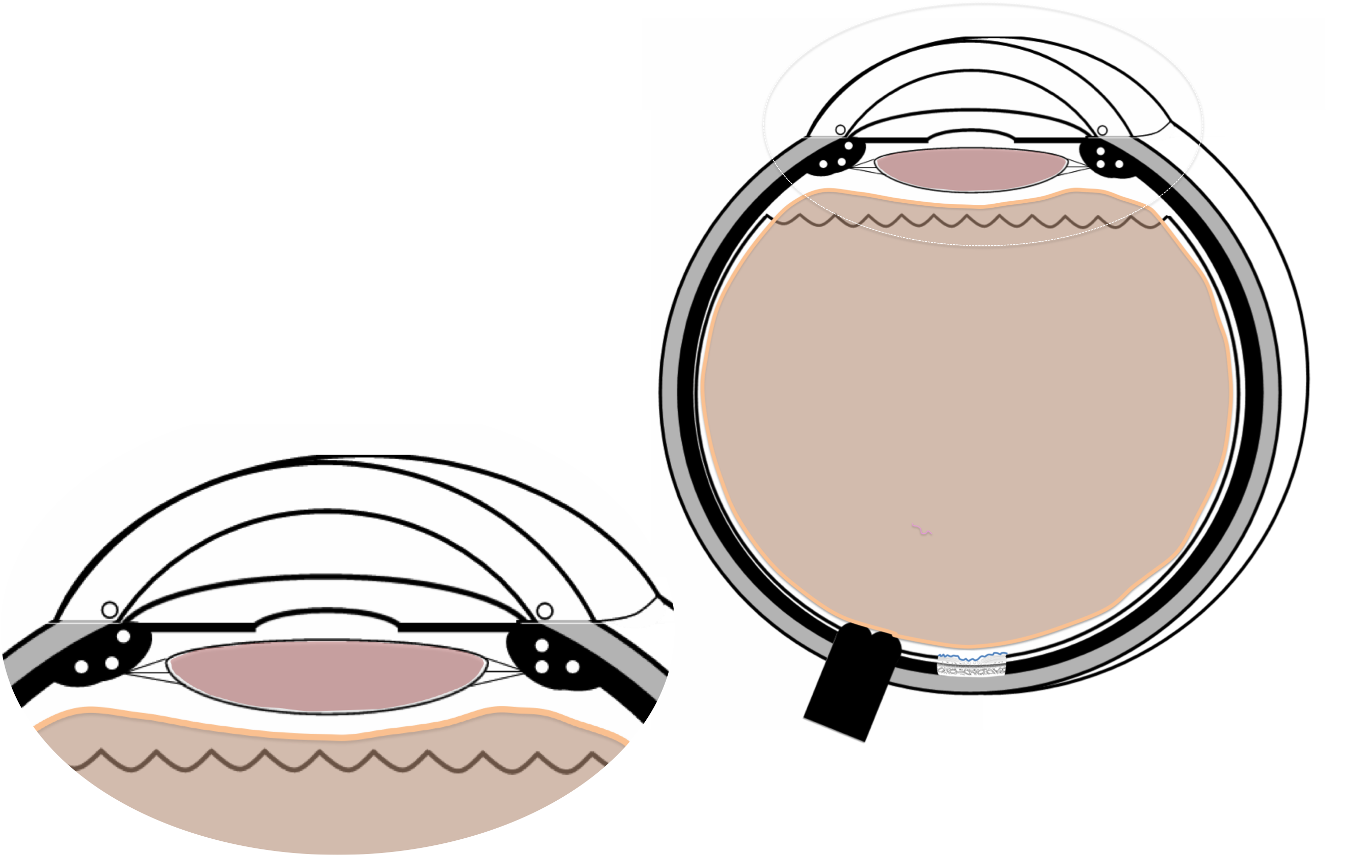 membrane épirétinienne prise en charge chirurgicale par vitrectomie : la cataracte s'accentue à distance de l'intervention