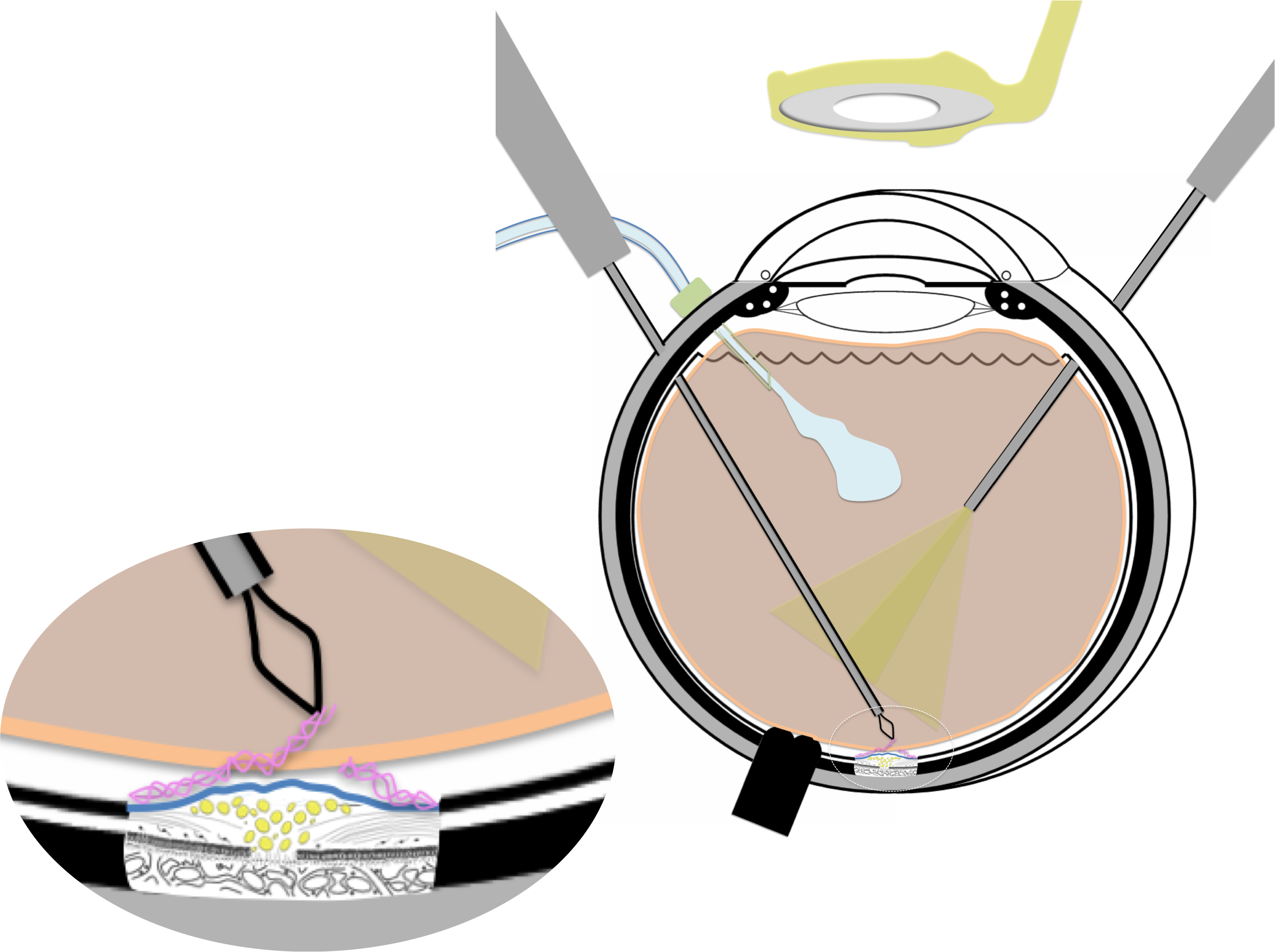 membrane épirétinienne prise en charge chirurgicale par vitrectomie : la membrane est délicatement saisie à l'aide d'une micro-pince pour être extraite