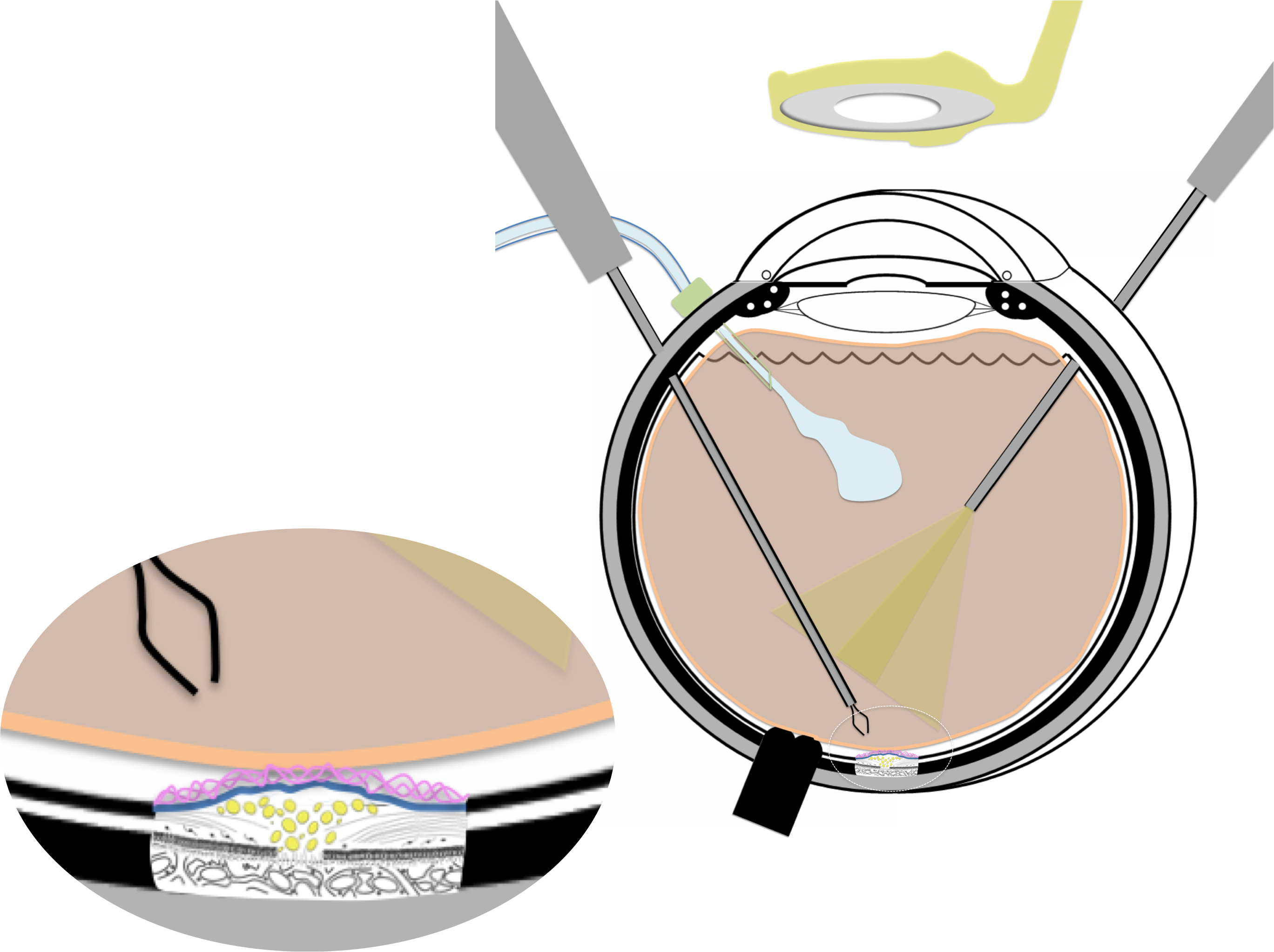 membrane épirétinienne prise en charge chirurgicale par vitrectomie : la micro-pince est introduite dans la cavité vitréenne à l'issue de la vitrectomie