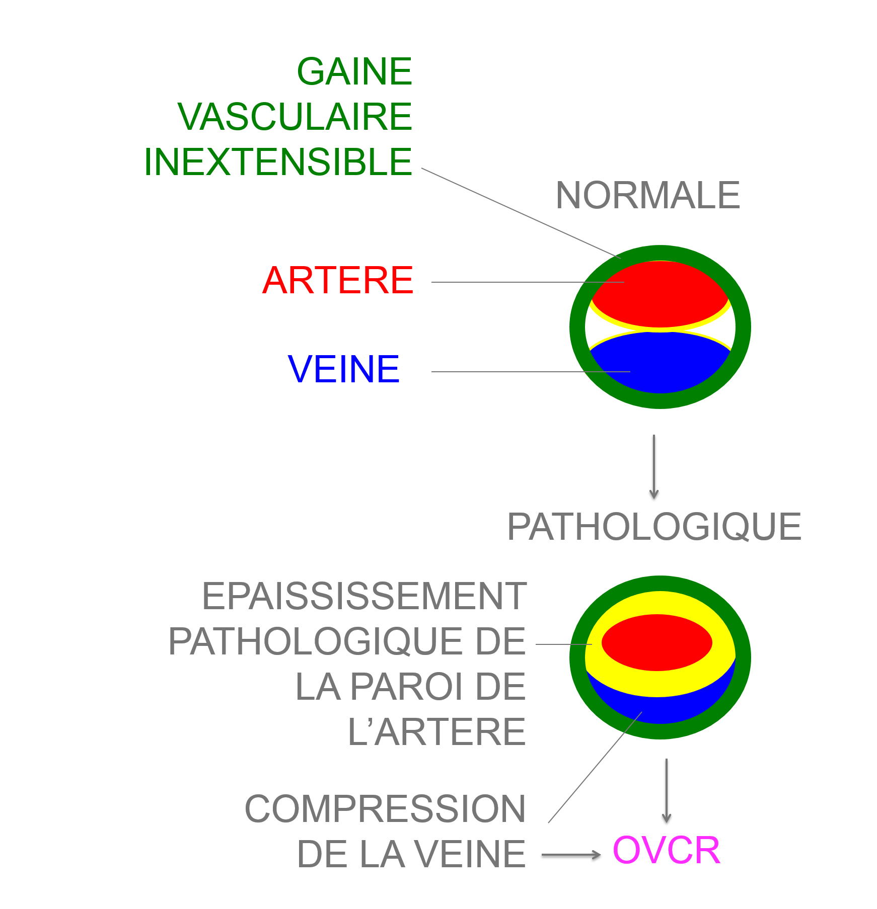 la compression de la veine par l'artère en cause dans la survenue des occlusions de veine de la rétine