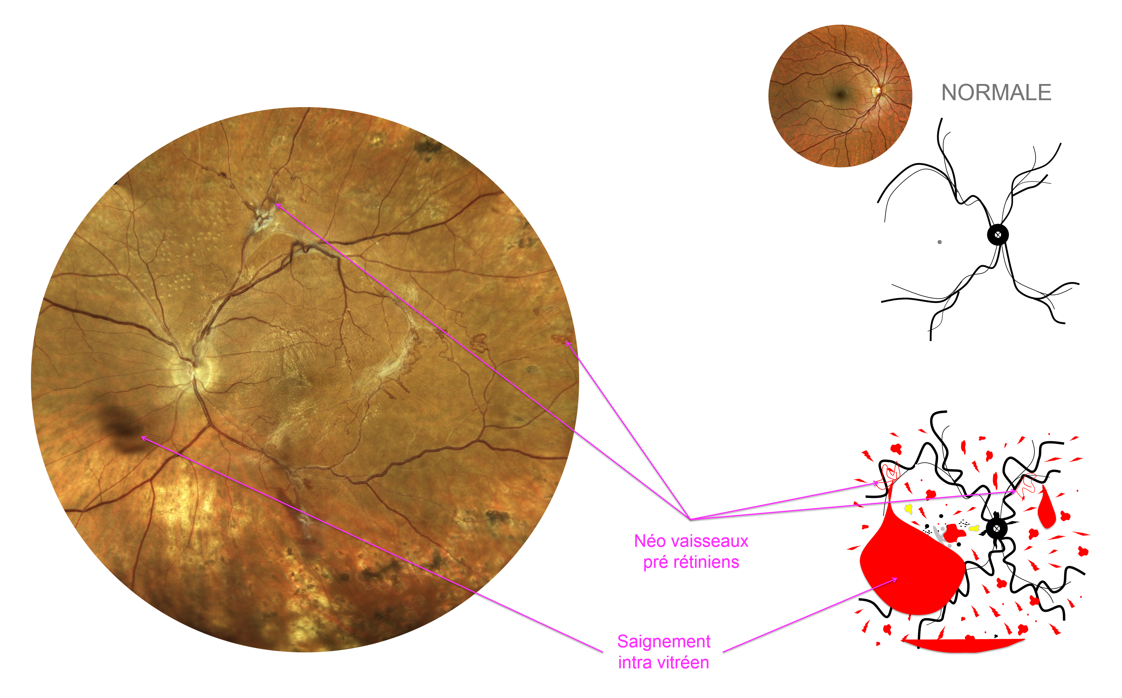néovaisseaux pré rétiniens compliquant une occlusion de veine de la rétine
