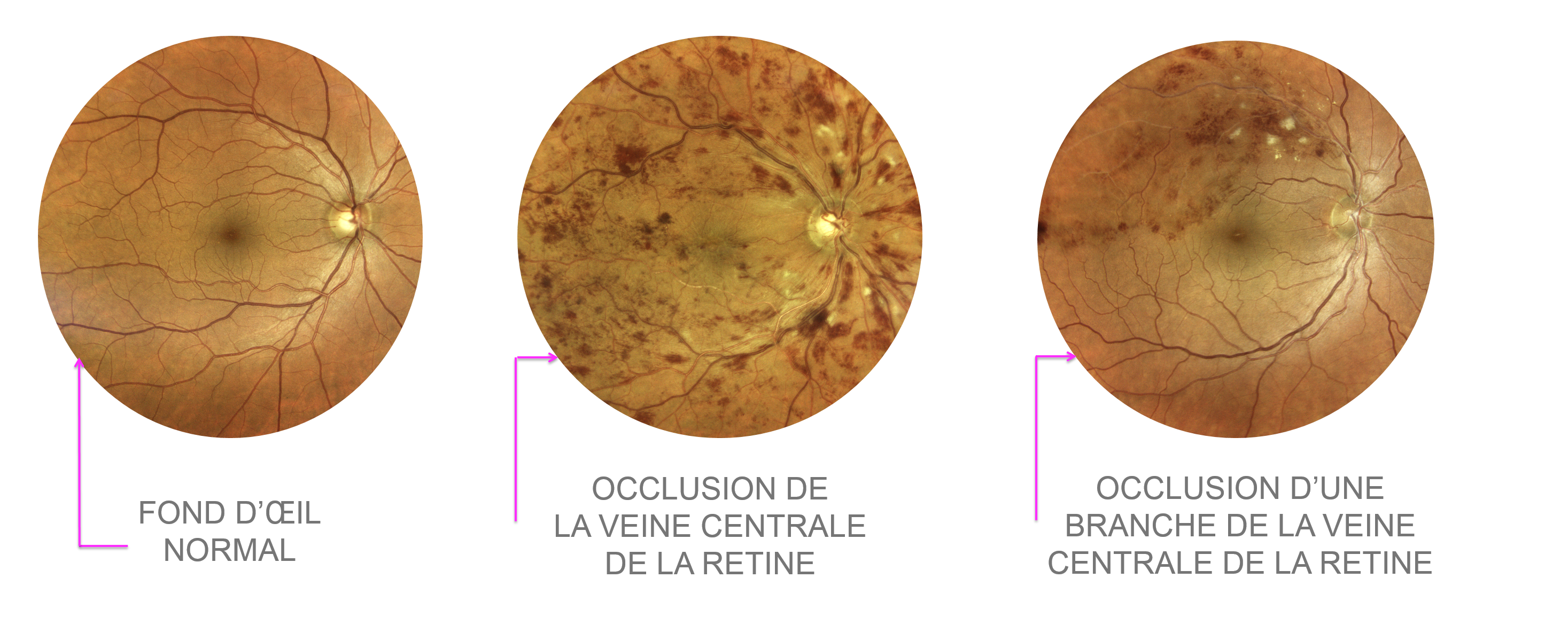 image de fond d'oeil normal, occlusion de veine centrale de la rétine (OVCR) et occlusion de branche de veine centrale de la rétine (OBVCR ou OBVR) 