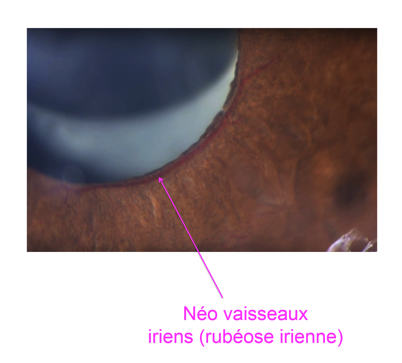 la compression de la veine par l'artère en cause dans la survenue des occlusions de veine de la rétine source de stave veineuse à l'origine des signes exsudatifs types hémorragies et oedèmes rétiniens