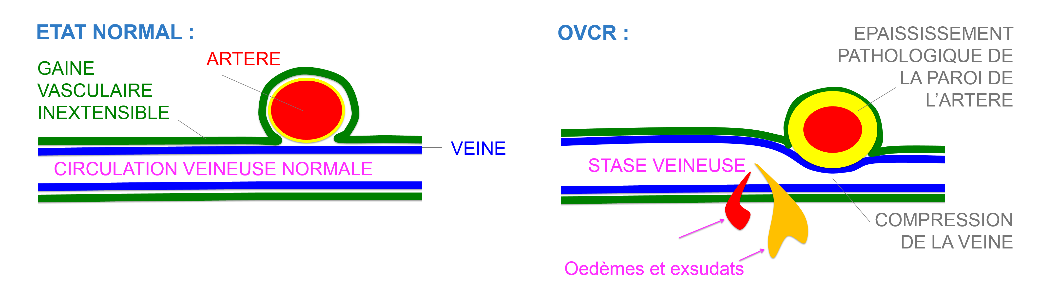 la compression de la veine par l'artère en cause dans la survenue des occlusions de veine de la rétine source de stave veineuse à l'origine des signes exsudatifs types hémorragies et oedèmes rétiniens