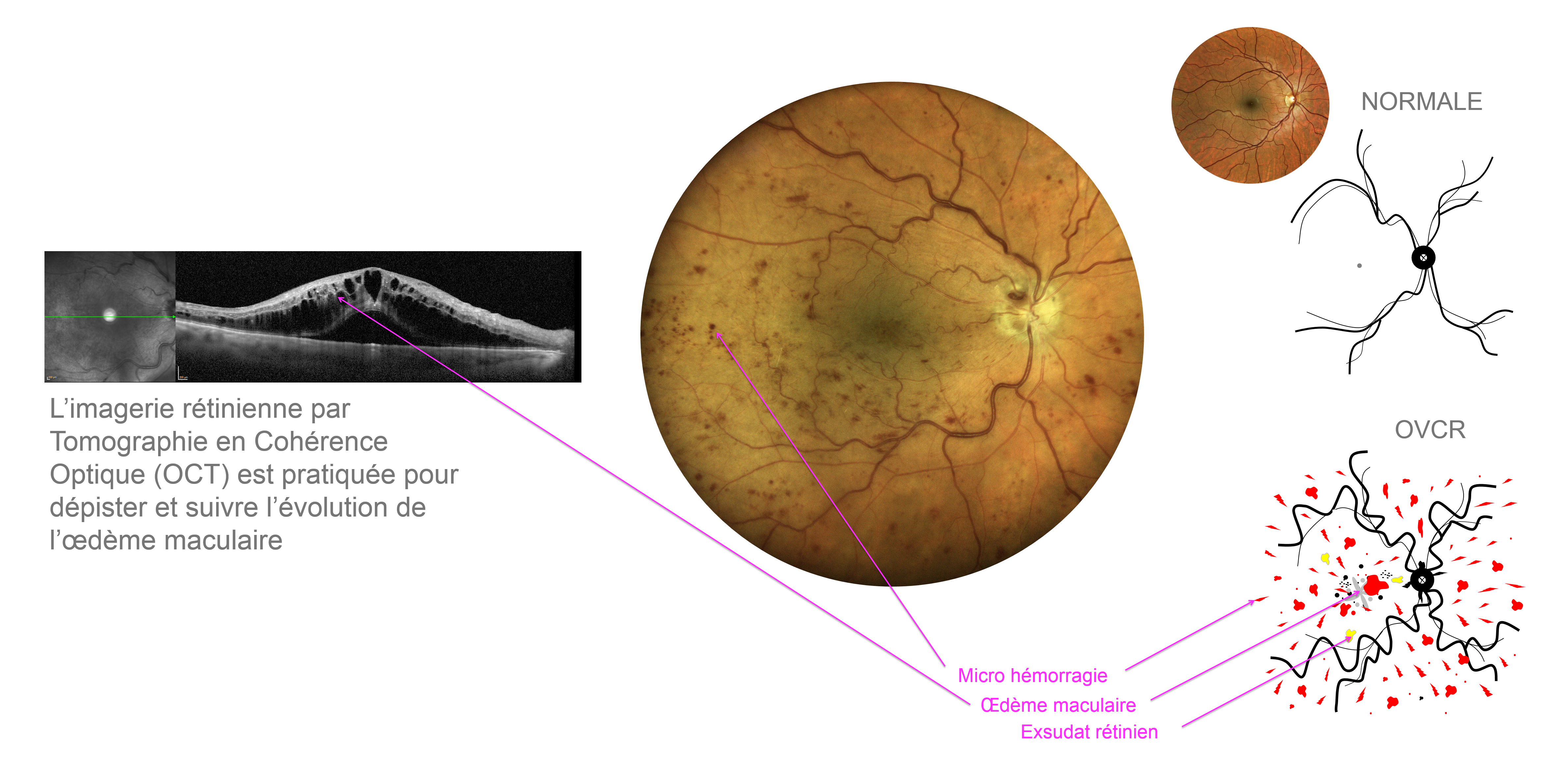 les signes d'examens visibles à l'examen du fond d'oeil et à l'OCT en cas d'occlusion de veine de la rétine