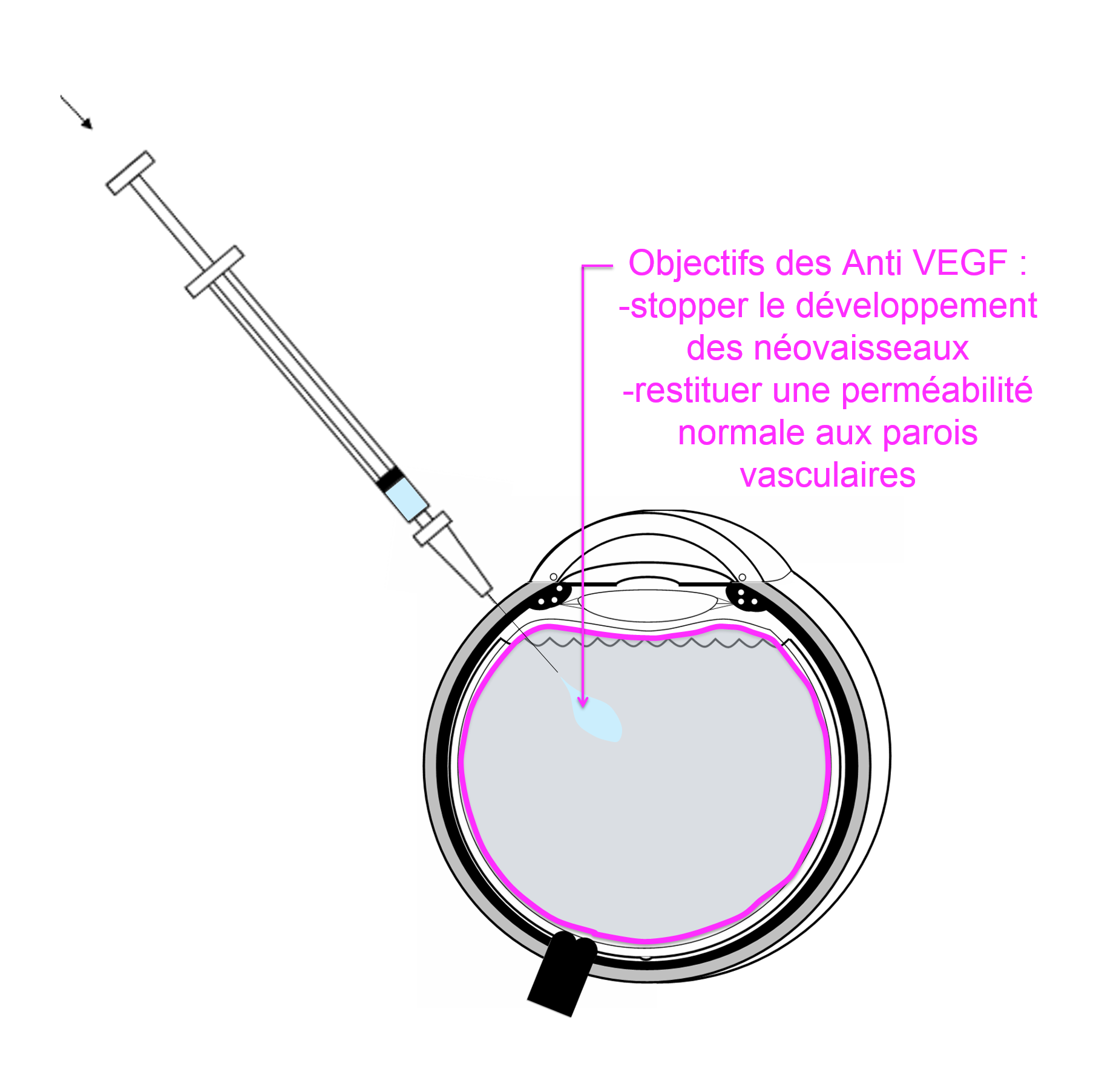 injection intra vitréenne d'anti VEGF pour le traitement d'une occlusion de veine de la rétine compliquée d'oedème maculaire