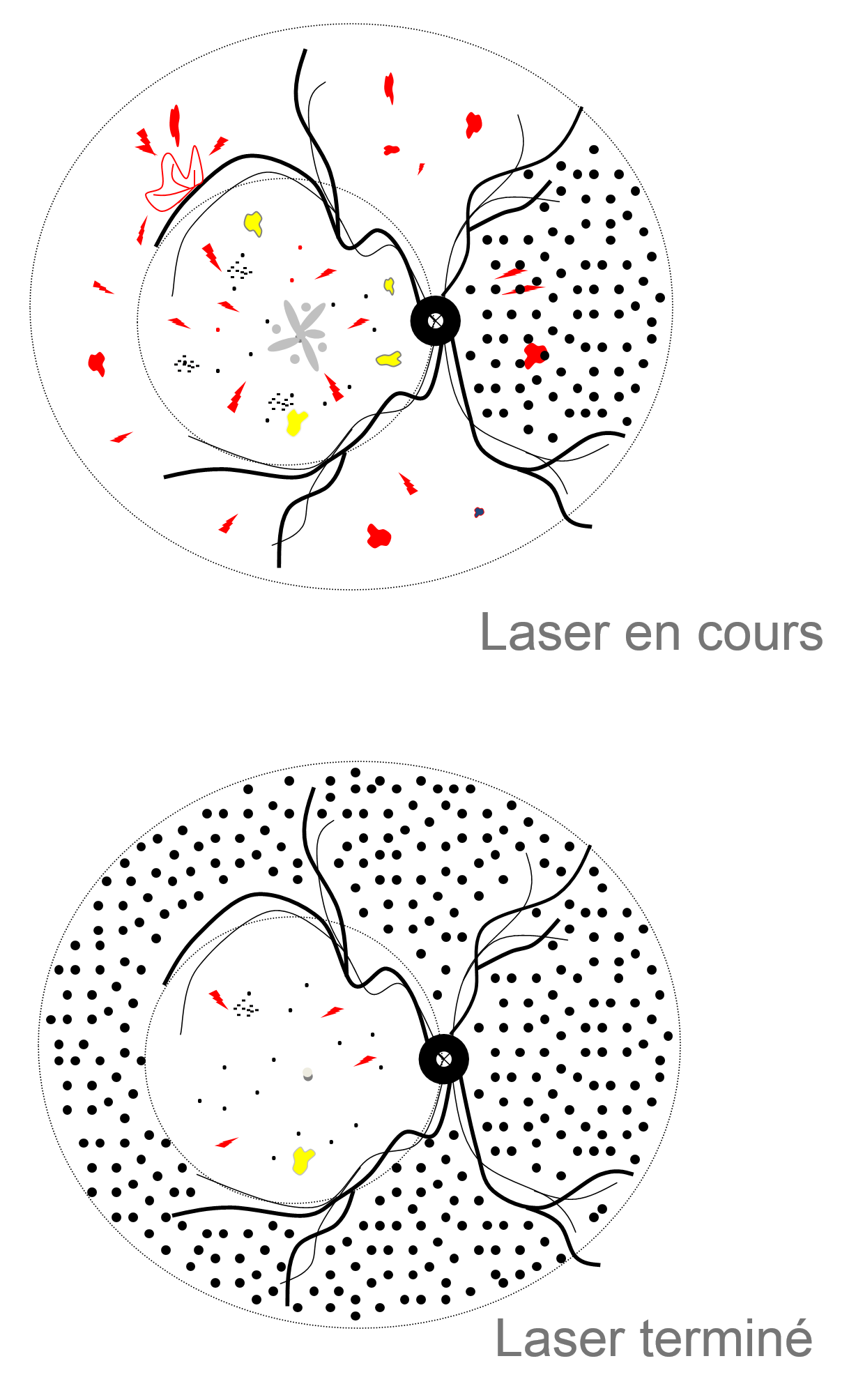 photocoagulation laser pour le traitement d'une occlusion de veine de la rétine compliquée de néovaisseaux pré rétiniens