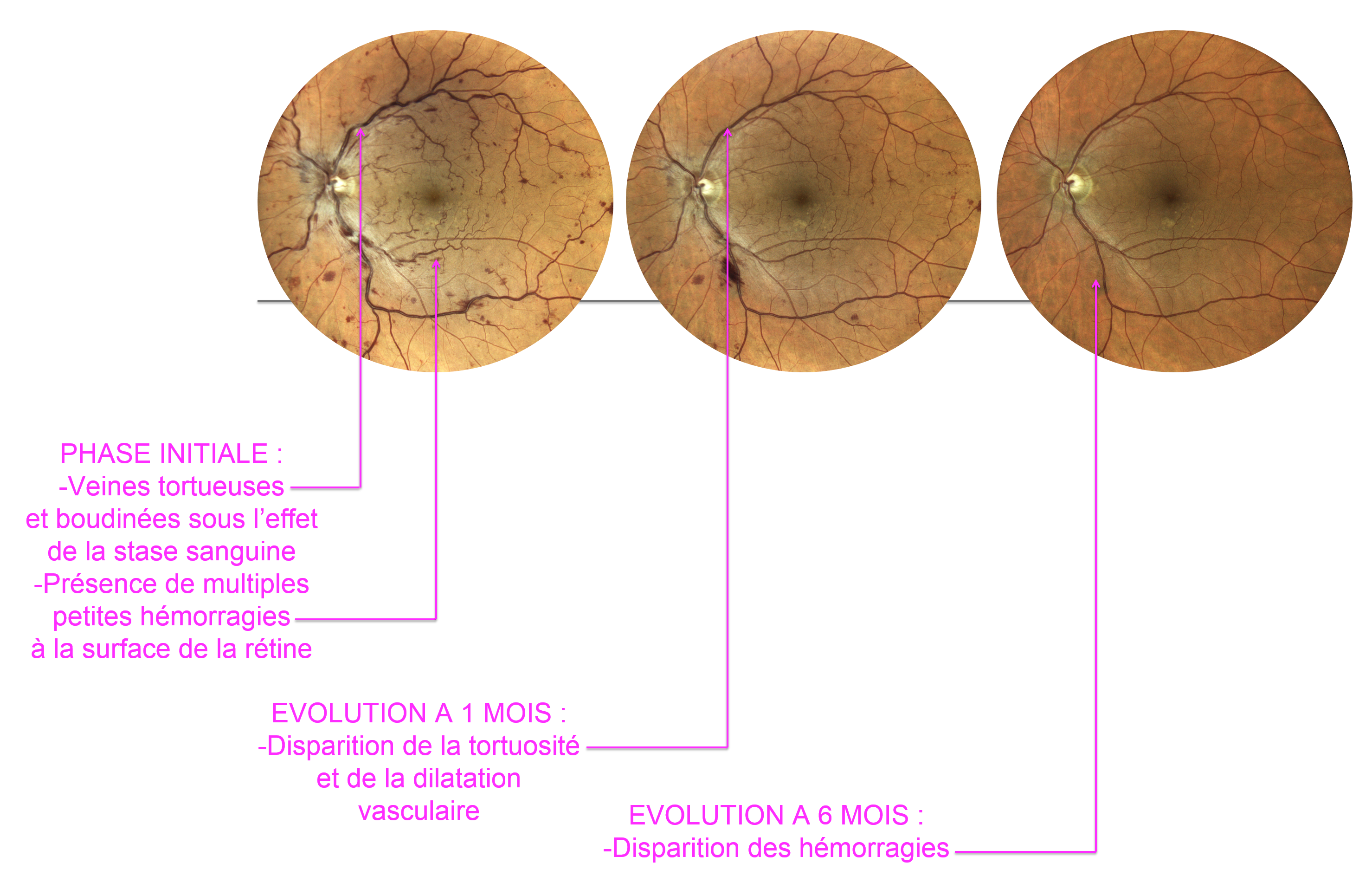 évolution spontannément favorable d'une occlusion de veine de la rétine