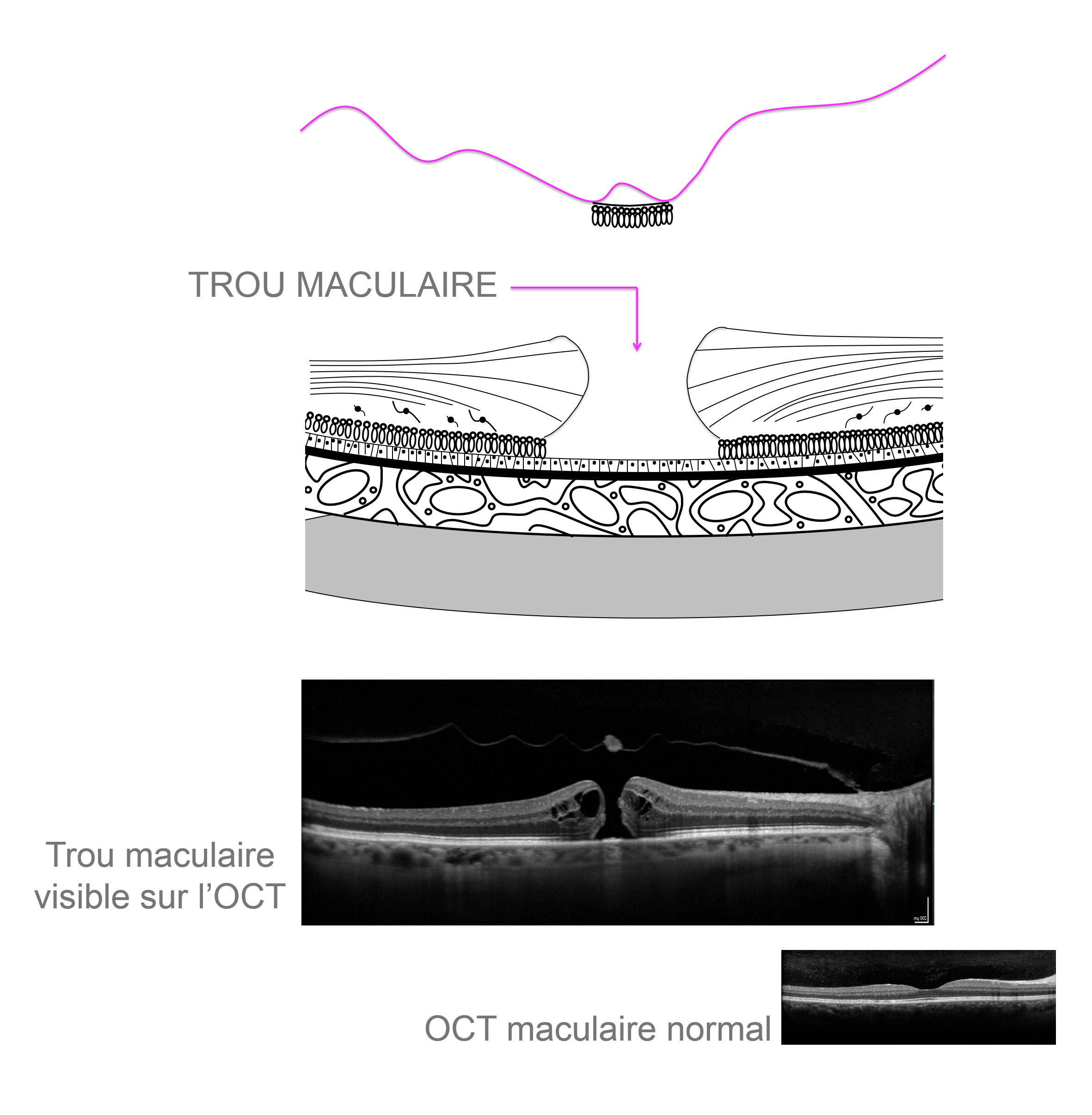 Trou maculaire mis en évidence sur l'imagerie OCT