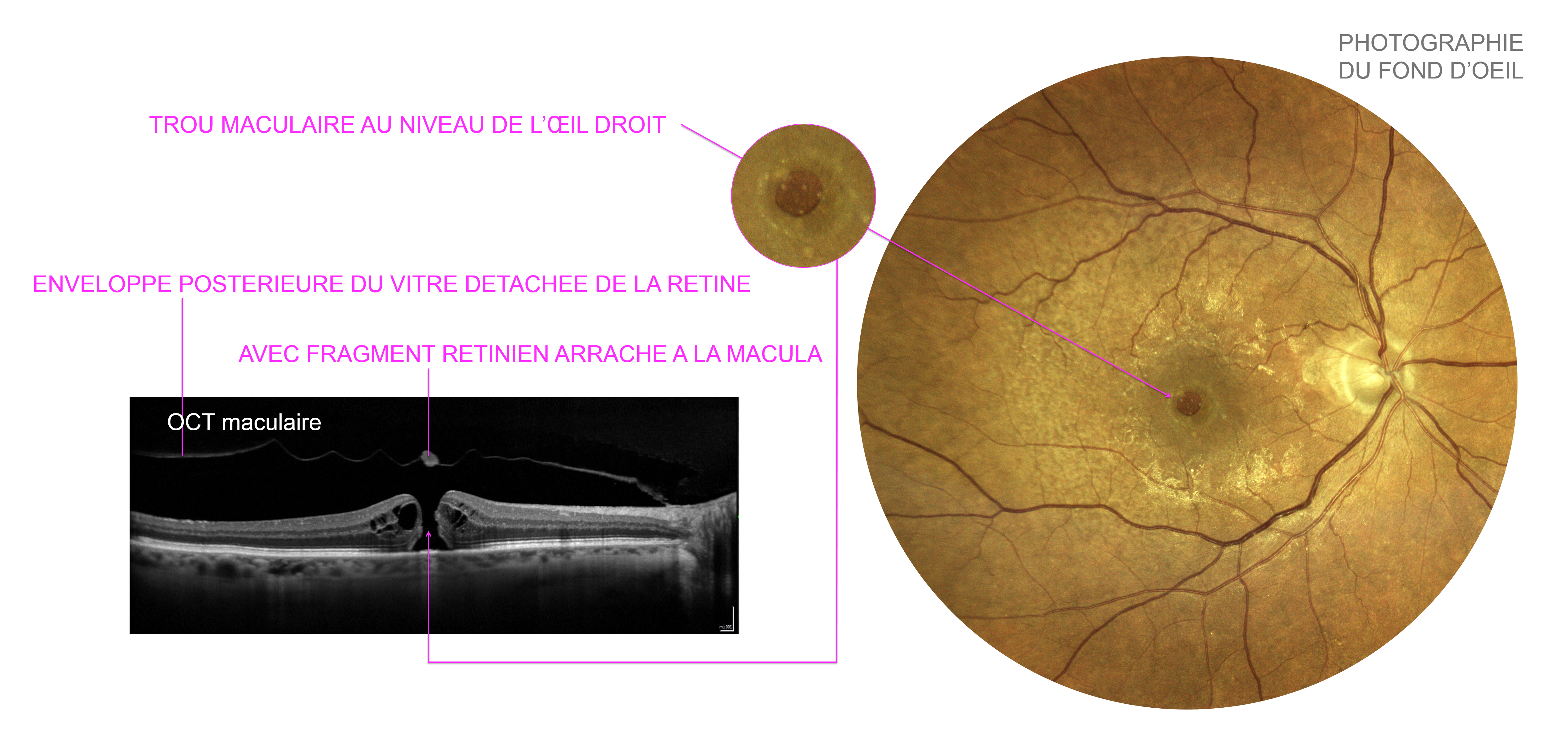 Trou maculaire mis en évidence sur l'imagerie par photographie du fond d'oeil et OCT