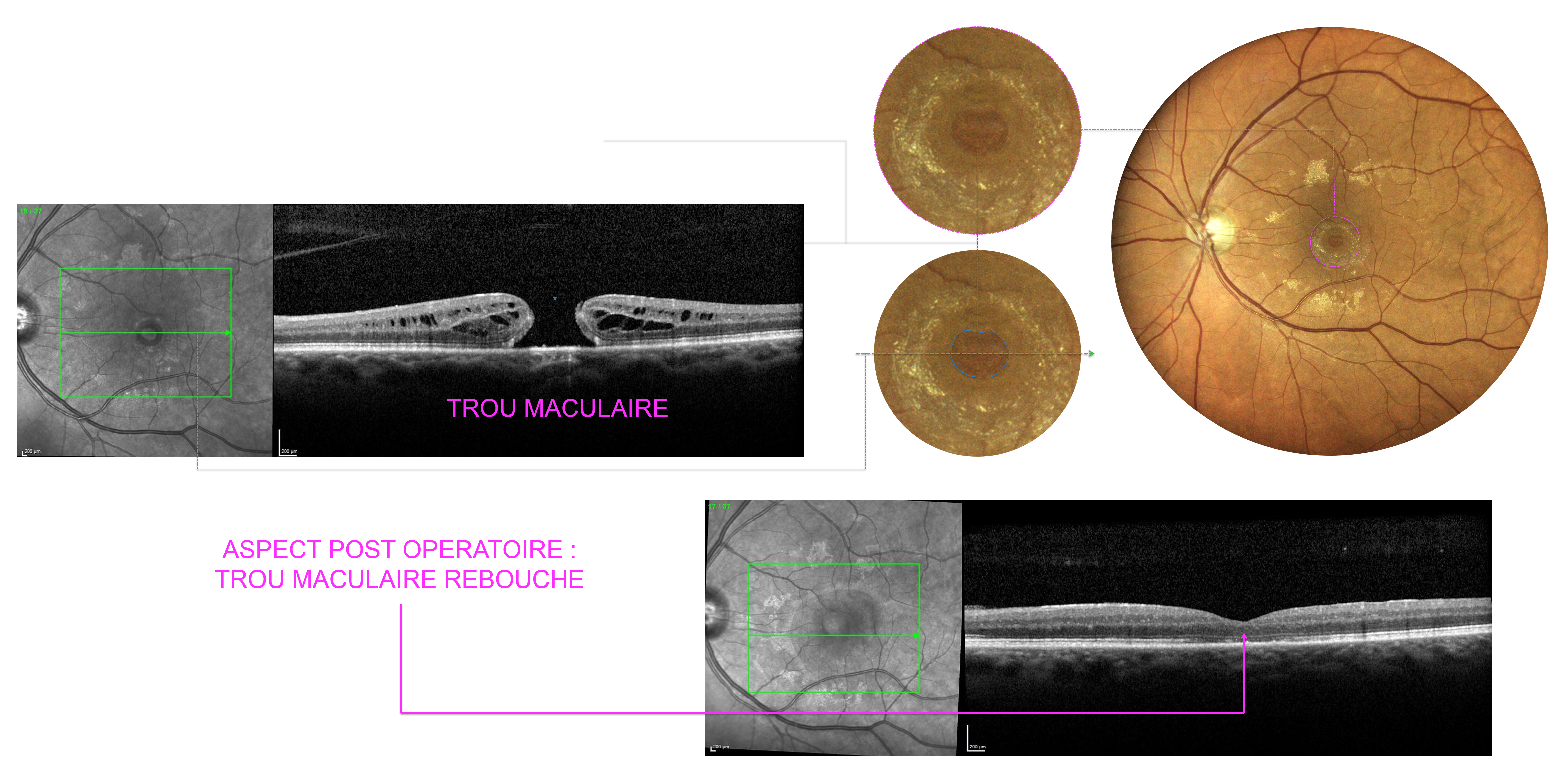 Chirurgie de trou maculaire au bloc opératoire de la clinique du Val d'Ouest à Lyon : comparaison de l'aspect pré et post opératoire obtenu après la fermeture du trou maculaire