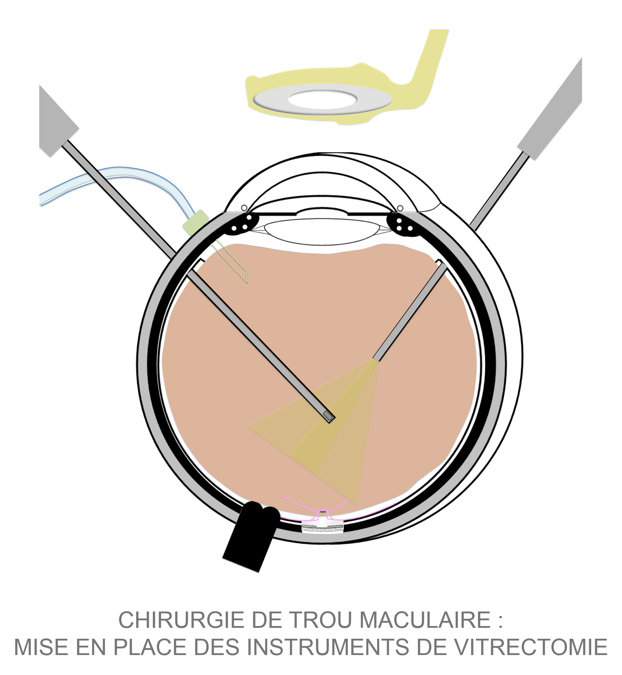 Chirurgie de trou maculaire au bloc opératoire de la clinique du Val d'Ouest à Lyon : mise en place des instruments pour la vitrectomie