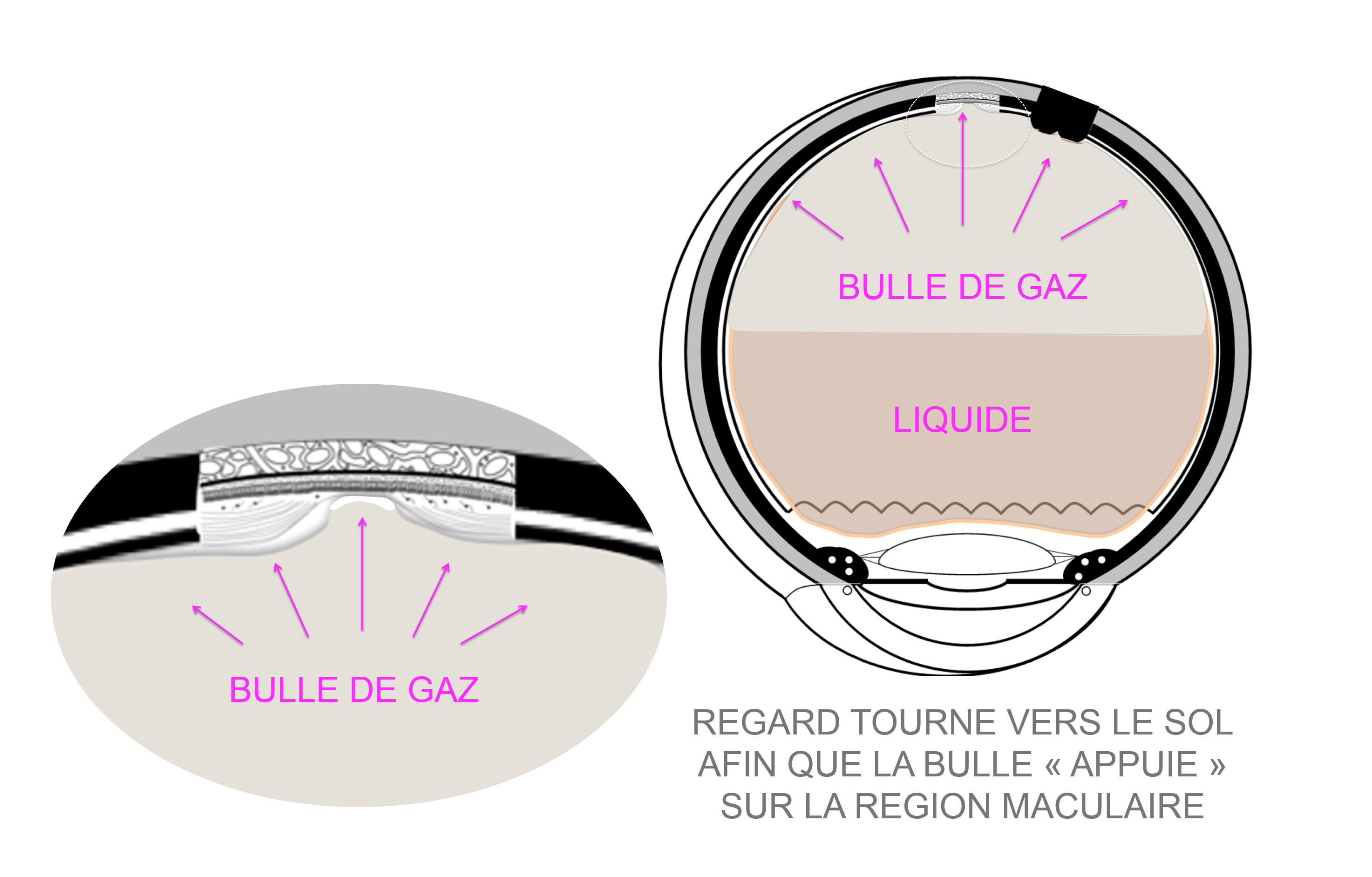 Chirurgie de trou maculaire au bloc opératoire de la clinique du Val d'Ouest à Lyon : position bulle regard tourné vers le sol afin que la bulle de gaz appuie sur la région maculaire et contribue à la fermeture du trou maculaire