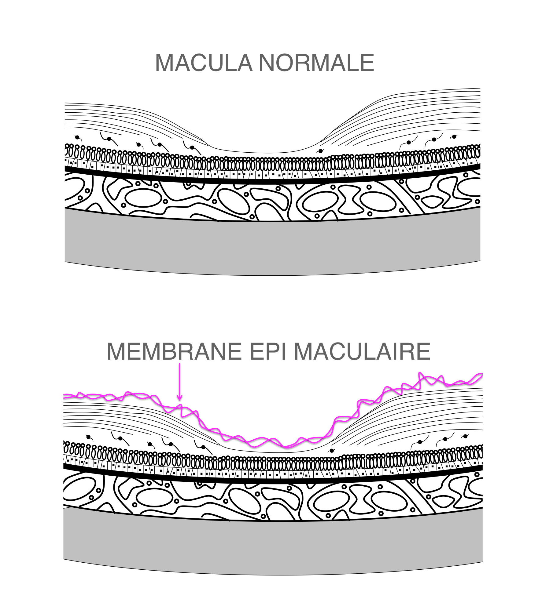 comparatif rétine normale et rétine présentant une membrane épirétinienne