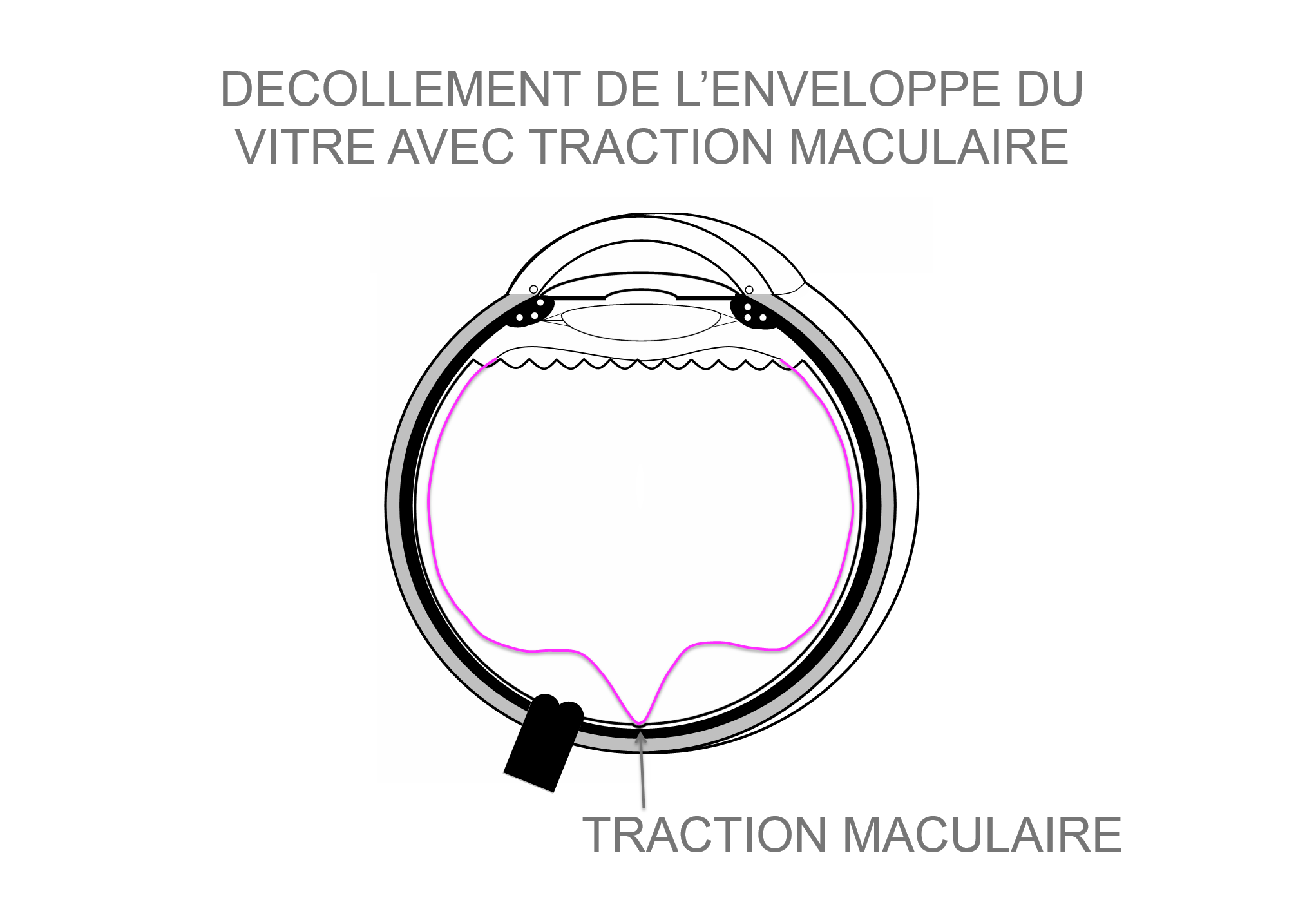 présence d'une traction vitréo-rétinienne en regard de la macula à risque de survenue d'un trou maculaire