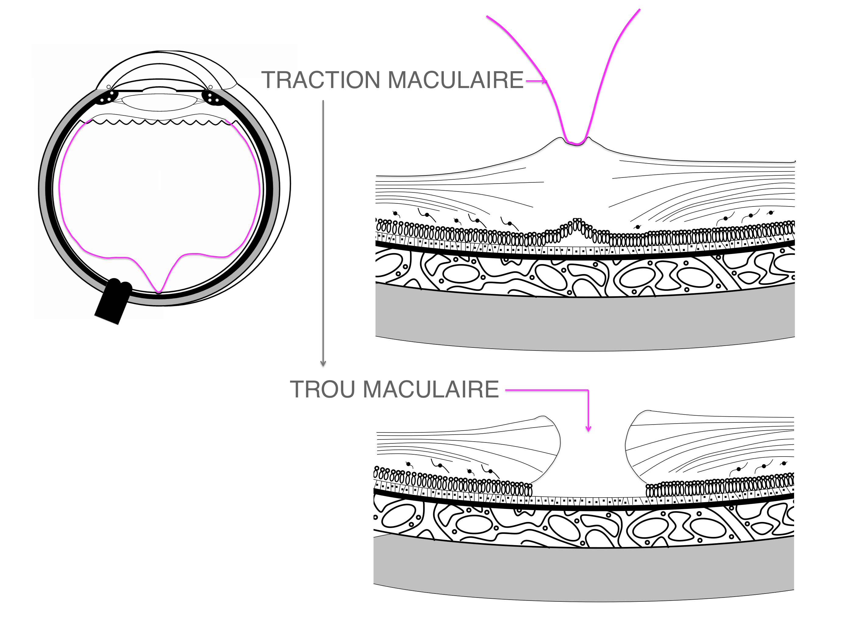 libération de la traction vitréo-maculaire à l'origine de la survenue d'un trou maculaire