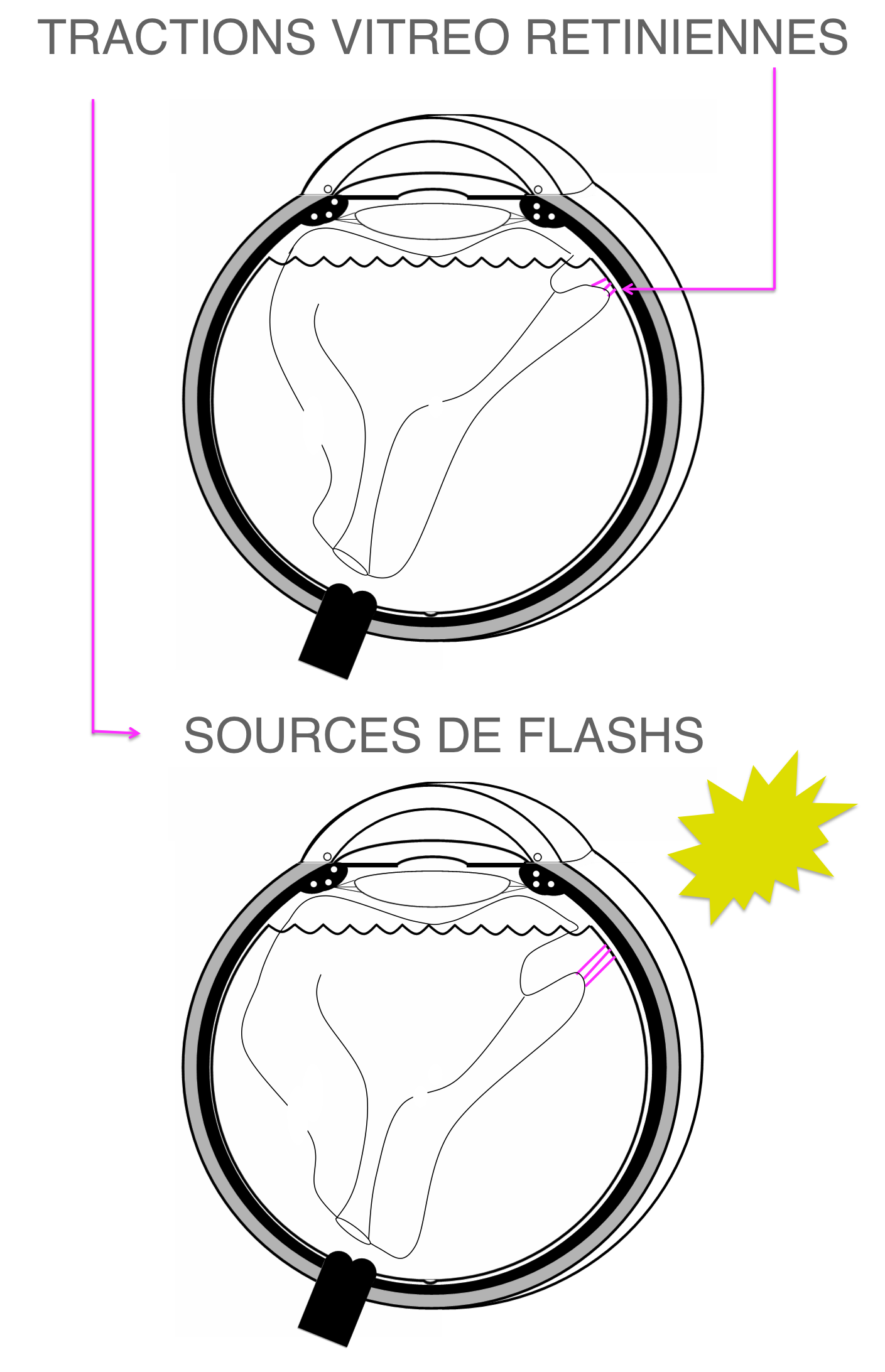 survenue de traction vitré rétinienne lors du décollement postérieur du vitré à l'origine de la perception d'éclairs lumineux (ou phosphènes) dans la vision