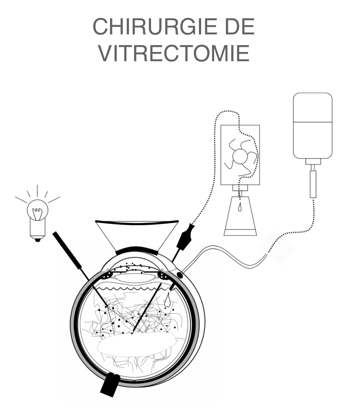 chirurgie de vitrectomie postérieure